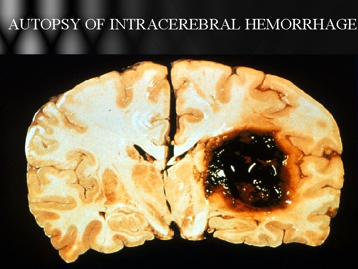 AUTOPSY OF INTRACEREBRAL HEMORRHAGE AUTOPSY OF INTRACEREBRAL HEMORRHAGE
