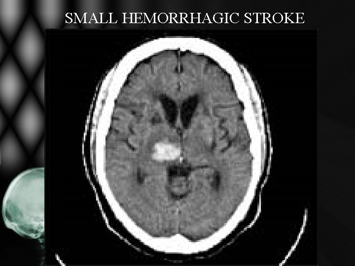SMALL HEMORRHAGIC STROKE SMALL HEMORRHAGIC STROKE