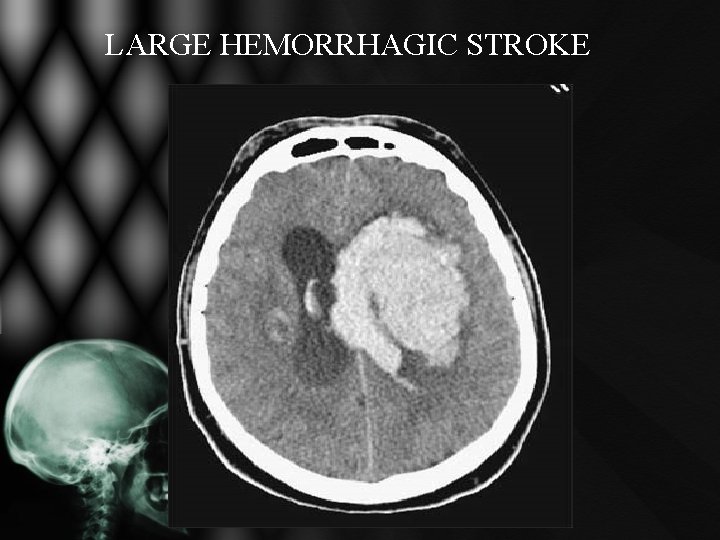 LARGE HEMORRHAGIC STROKE LARGE HEMORRHAGIC STROKE