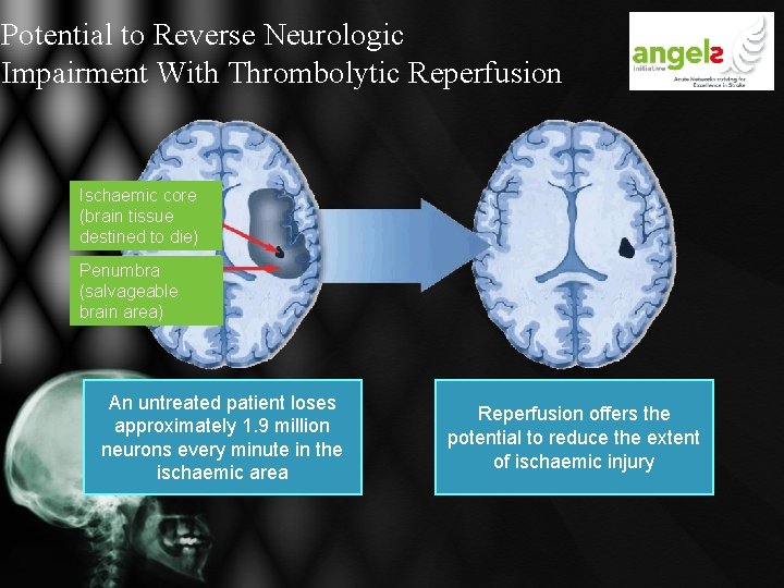 Potential to Reverse Neurologic Impairment With Thrombolytic Reperfusion Ischaemic core (brain tissue destined to Potential to Reverse Neurologic Impairment With Thrombolytic Reperfusion Ischaemic core (brain tissue destined to