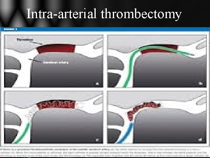 Intra-arterial thrombectomy Intra-arterial thrombectomy