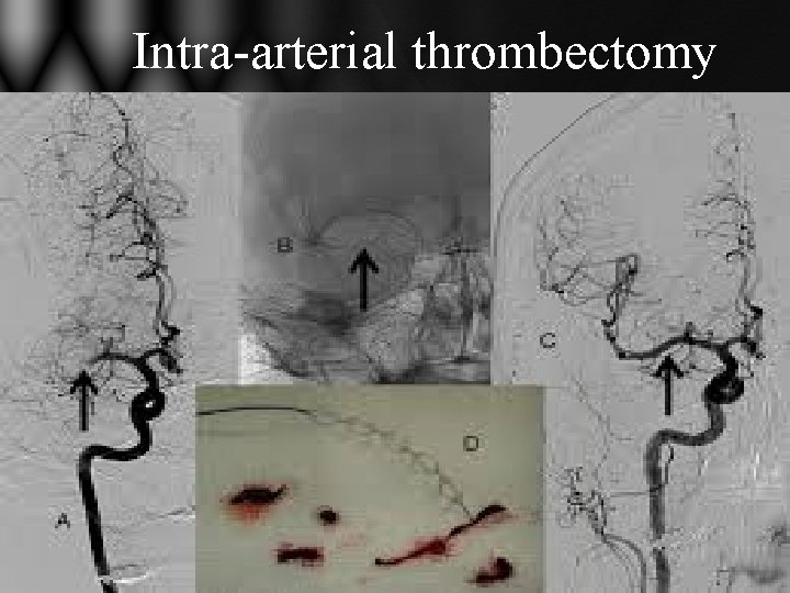 Intra-arterial thrombectomy Intra-arterial thrombectomy