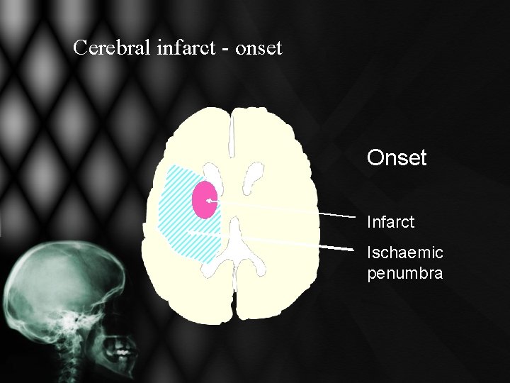 Cerebral infarct - onset Onset Infarct Ischaemic penumbra Cerebral infarct - onset Onset Infarct Ischaemic penumbra