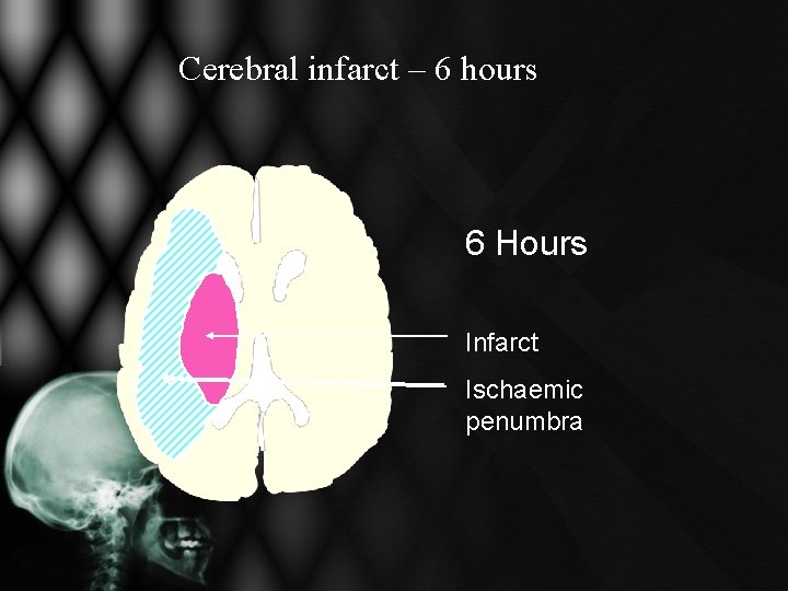 Cerebral infarct – 6 hours 6 Hours Infarct Ischaemic penumbra Cerebral infarct – 6 hours 6 Hours Infarct Ischaemic penumbra