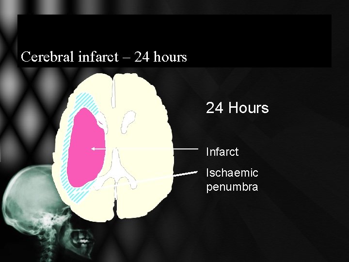 Cerebral infarct – 24 hours 24 Hours Infarct Ischaemic penumbra Cerebral infarct – 24 hours 24 Hours Infarct Ischaemic penumbra