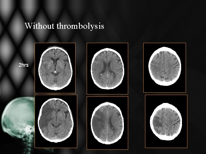Without thrombolysis 2 hrs Without thrombolysis 2 hrs