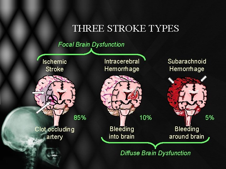 THREE STROKE TYPES Focal Brain Dysfunction Intracerebral Hemorrhage Ischemic Stroke 85% Clot occluding artery THREE STROKE TYPES Focal Brain Dysfunction Intracerebral Hemorrhage Ischemic Stroke 85% Clot occluding artery