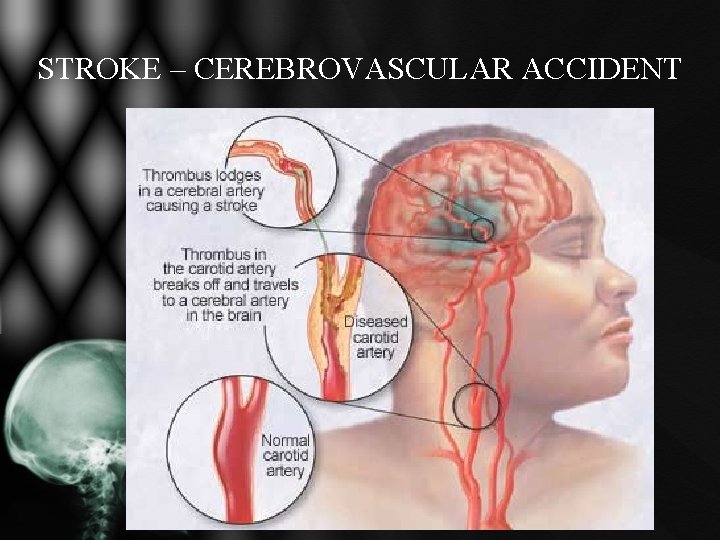 STROKE – CEREBROVASCULAR ACCIDENT STROKE – CEREBROVASCULAR ACCIDENT