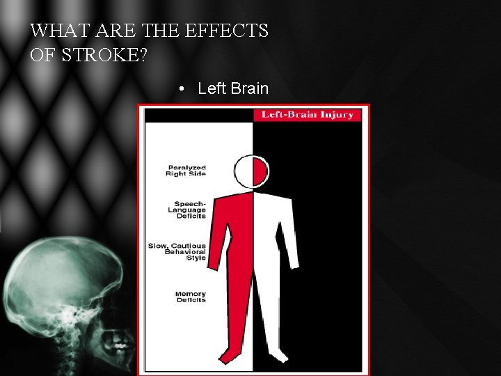 WHAT ARE THE EFFECTS OF STROKE? • Left Brain WHAT ARE THE EFFECTS OF STROKE? • Left Brain