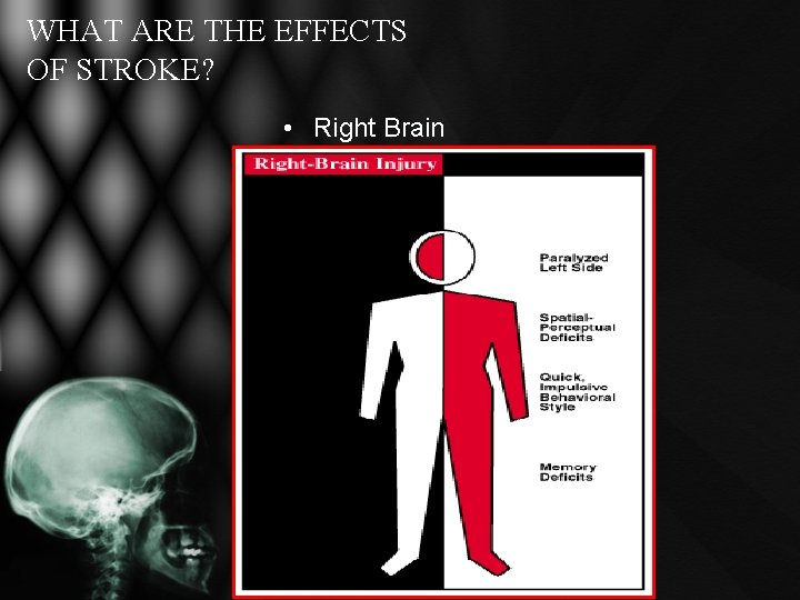WHAT ARE THE EFFECTS OF STROKE? • Right Brain WHAT ARE THE EFFECTS OF STROKE? • Right Brain