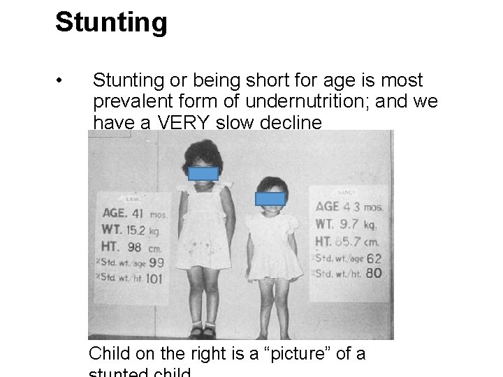 Stunting • Stunting or being short for age is most prevalent form of undernutrition;