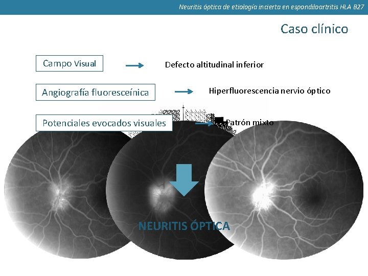 Neuritis óptica de etiología incierta en espondiloartritis HLA B 27 Caso clínico Campo Visual