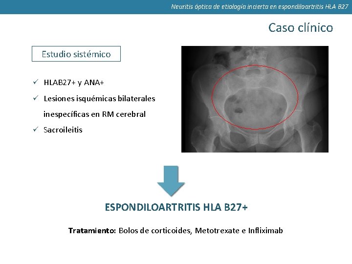 Neuritis óptica de etiología incierta en espondiloartritis HLA B 27 Caso clínico Estudio sistémico