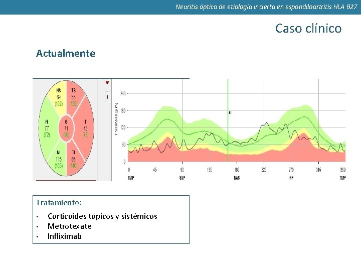 Neuritis óptica de etiología incierta en espondiloartritis HLA B 27 Caso clínico Actualmente MAVC