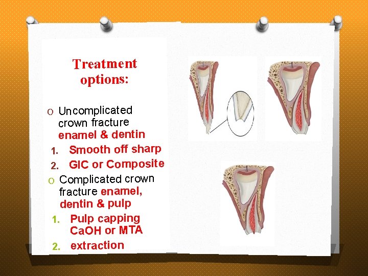 Treatment options: O Uncomplicated crown fracture enamel & dentin 1. Smooth off sharp 2.