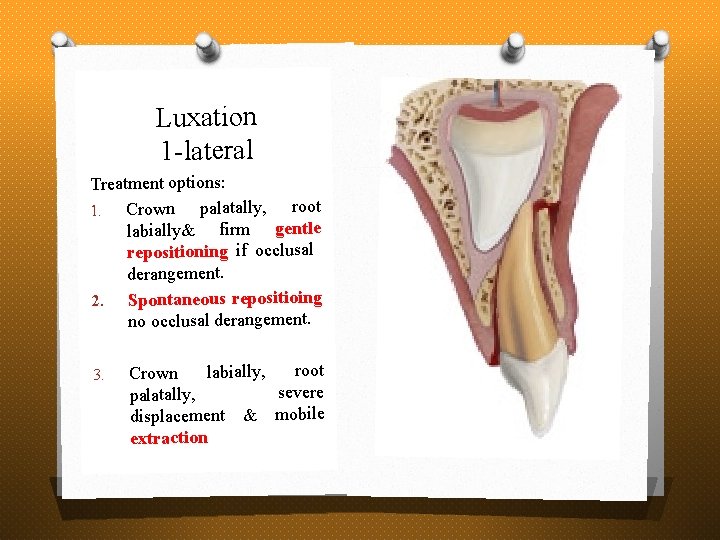 Luxation 1 -lateral Treatment options: Crown palatally, root 1. labially& firm gentle repositioning if