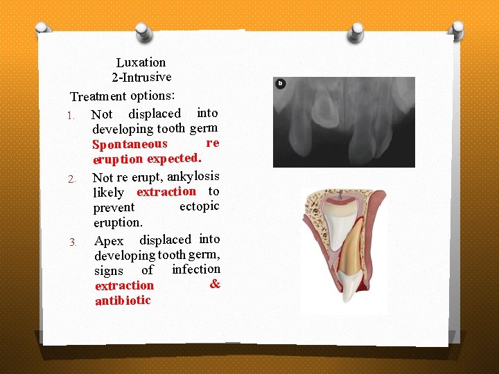 Luxation 2 -Intrusive Treatment options: 1. Not displaced into developing tooth germ re Spontaneous