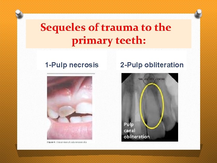 Sequeles of trauma to the primary teeth: 1 -Pulp necrosis 2 -Pulp obliteration 