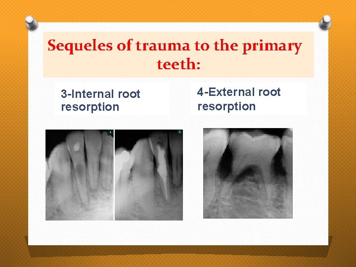 Sequeles of trauma to the primary teeth: 3 -Internal root resorption 4 -External root