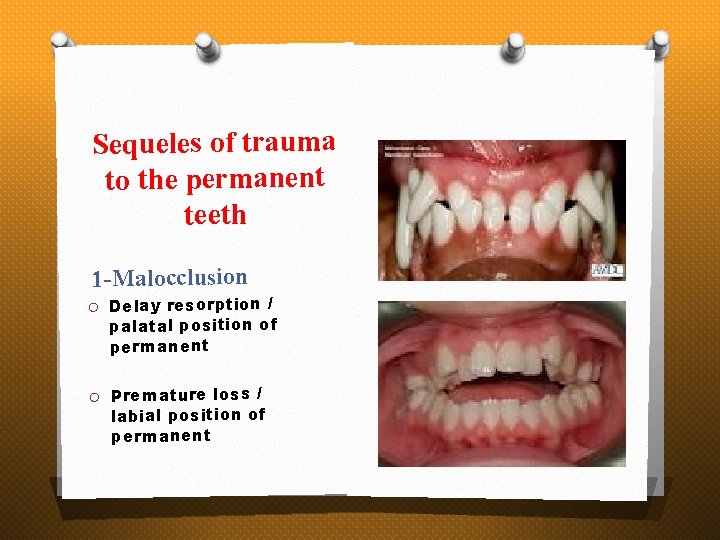Sequeles of trauma to the permanent teeth 1 -Malocclusion O Delay resorption / palatal