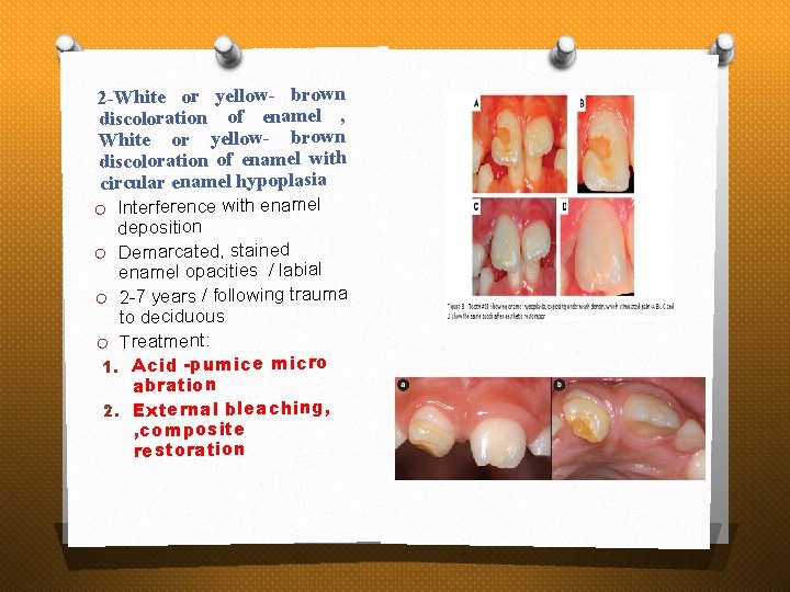 2 -White or yellow- brown discoloration of enamel , White or yellow- brown discoloration