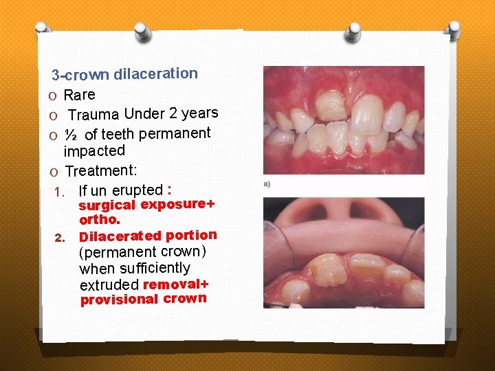 3 -crown dilaceration O Rare O Trauma Under 2 years O ½ of teeth