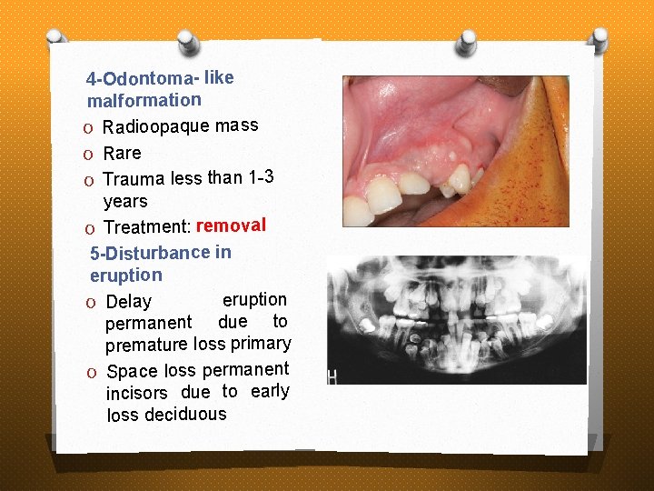 4 -Odontoma- like malformation O Radioopaque mass O Rare O Trauma less than 1