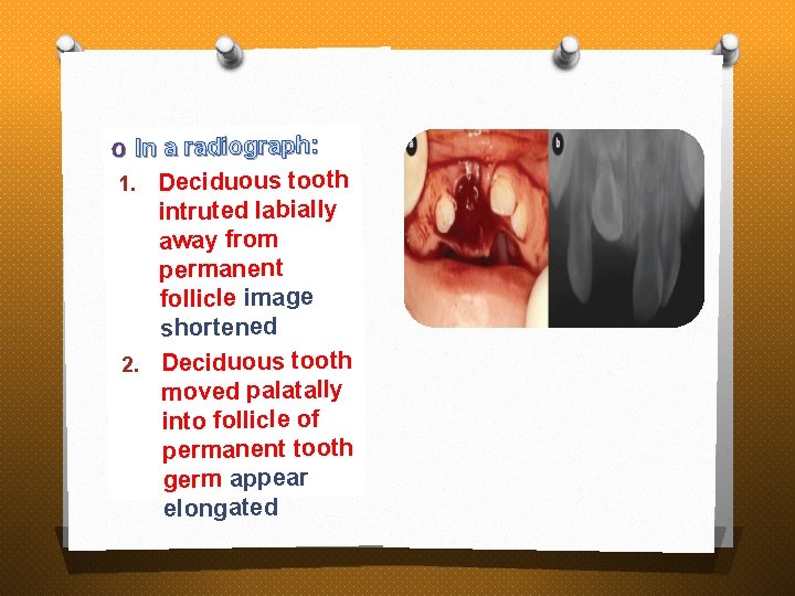 O In a radiograph: Deciduous tooth intruted labially away from permanent follicle image shortened