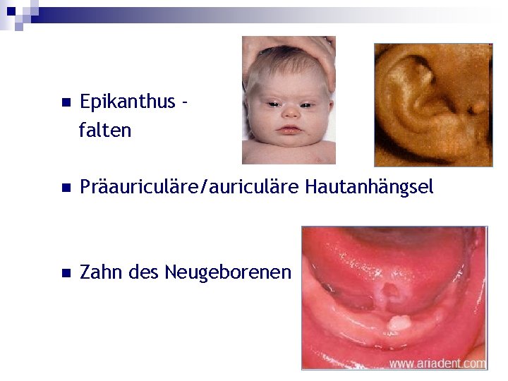 n Epikanthus falten n Präauriculäre/auriculäre Hautanhängsel n Zahn des Neugeborenen 