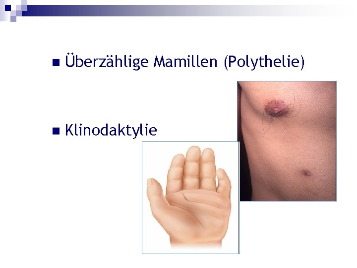 n Überzählige Mamillen (Polythelie) n Klinodaktylie 