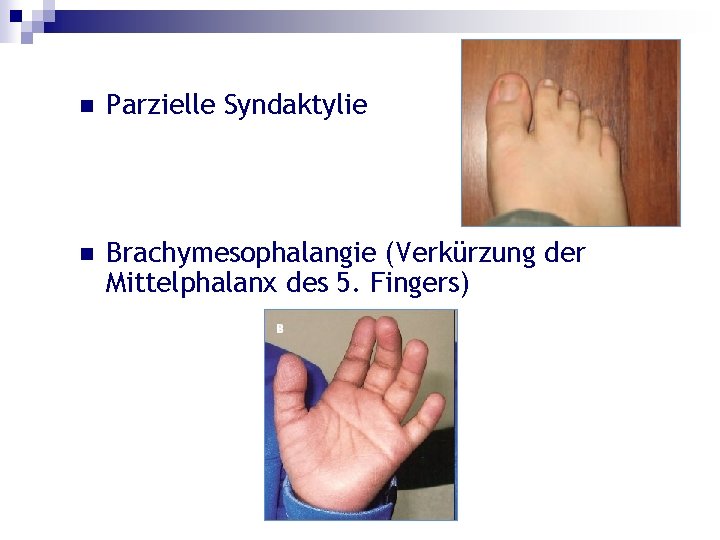 n Parzielle Syndaktylie n Brachymesophalangie (Verkürzung der Mittelphalanx des 5. Fingers) 