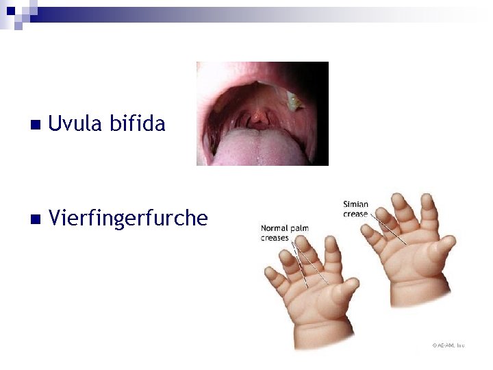 n Uvula bifida n Vierfingerfurche 