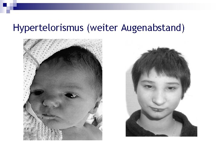 Hypertelorismus (weiter Augenabstand) 