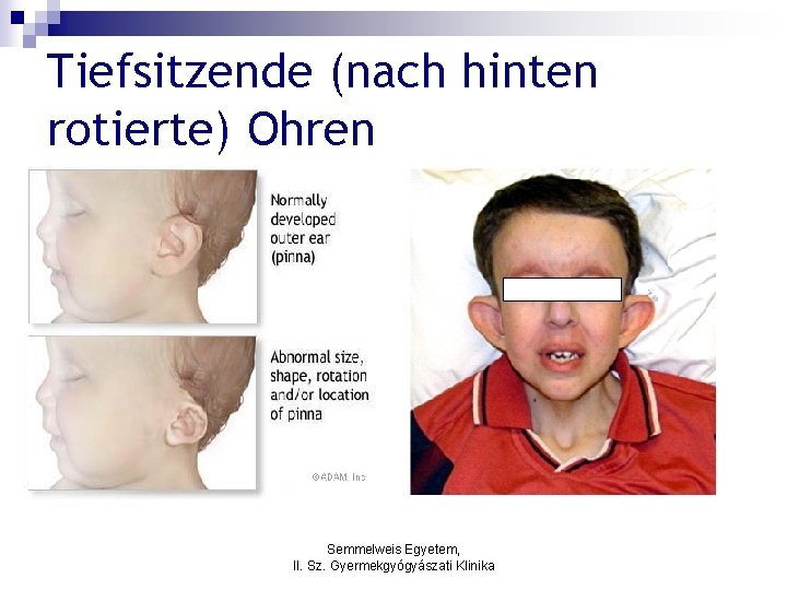 Tiefsitzende (nach hinten rotierte) Ohren Semmelweis Egyetem, II. Sz. Gyermekgyógyászati Klinika 