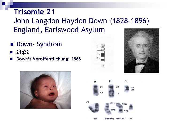 Trisomie 21 John Langdon Haydon Down (1828 -1896) England, Earlswood Asylum n Down- Syndrom