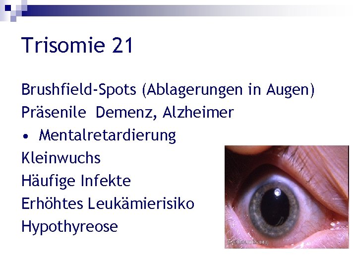 Trisomie 21 Brushfield-Spots (Ablagerungen in Augen) Präsenile Demenz, Alzheimer • Mentalretardierung Kleinwuchs Häufige Infekte