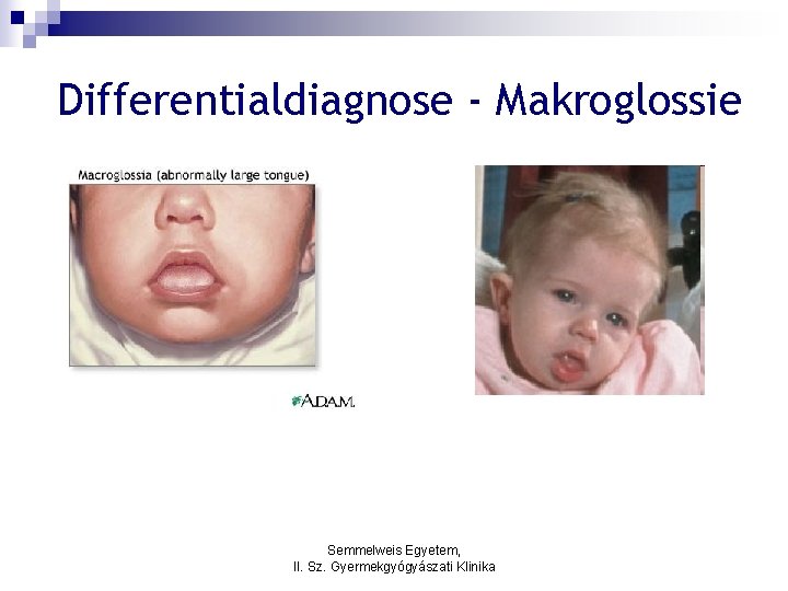 Differentialdiagnose - Makroglossie Semmelweis Egyetem, II. Sz. Gyermekgyógyászati Klinika 