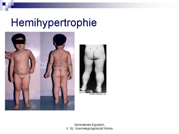 Hemihypertrophie Semmelweis Egyetem, II. Sz. Gyermekgyógyászati Klinika 