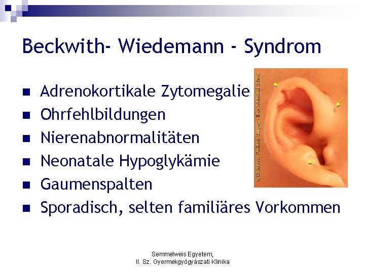 Beckwith- Wiedemann - Syndrom n n n Adrenokortikale Zytomegalie Ohrfehlbildungen Nierenabnormalitäten Neonatale Hypoglykämie Gaumenspalten