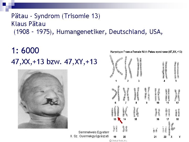 Pätau - Syndrom (Trisomie 13) Klaus Pätau (1908 – 1975), Humangenetiker, Deutschland, USA, 1: