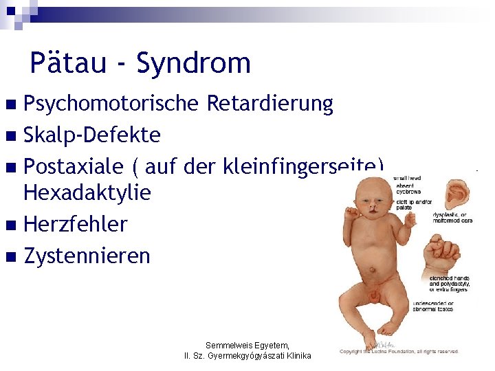 Pätau - Syndrom Psychomotorische Retardierung n Skalp-Defekte n Postaxiale ( auf der kleinfingerseite) Hexadaktylie