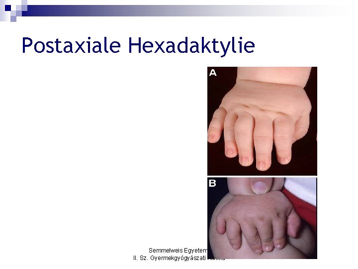 Postaxiale Hexadaktylie Semmelweis Egyetem, II. Sz. Gyermekgyógyászati Klinika 