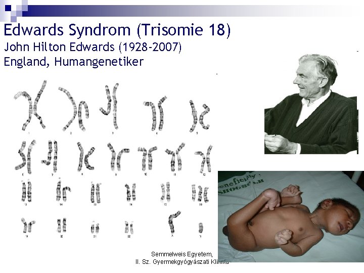 Edwards Syndrom (Trisomie 18) John Hilton Edwards (1928 -2007) England, Humangenetiker Semmelweis Egyetem, II.