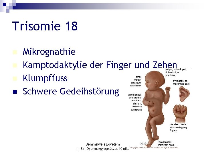 Trisomie 18 n n Mikrognathie Kamptodaktylie der Finger und Zehen Klumpffuss Schwere Gedeihstörung Semmelweis