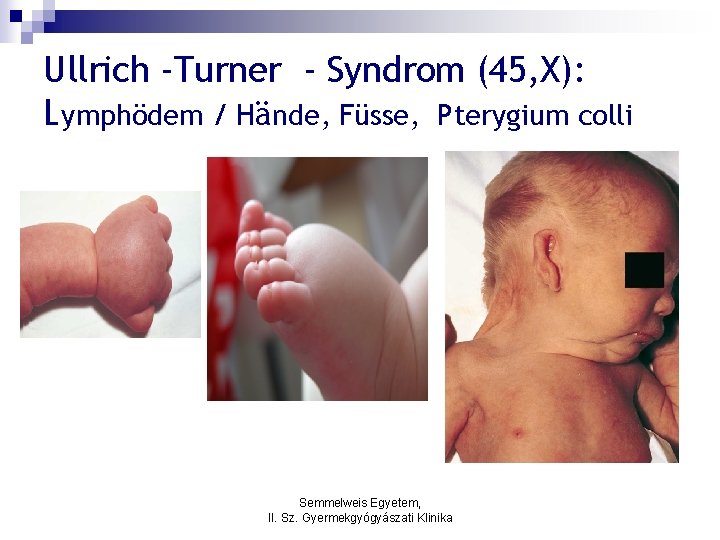 Ullrich -Turner - Syndrom (45, X): Lymphödem / Hände, Füsse, Pterygium colli Semmelweis Egyetem,