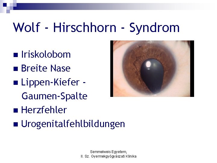 Wolf - Hirschhorn - Syndrom Iriskolobom n Breite Nase n Lippen-Kiefer Gaumen-Spalte n Herzfehler