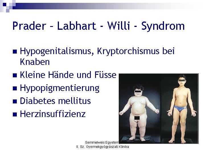 Prader – Labhart - Willi - Syndrom Hypogenitalismus, Kryptorchismus bei Knaben n Kleine Hände