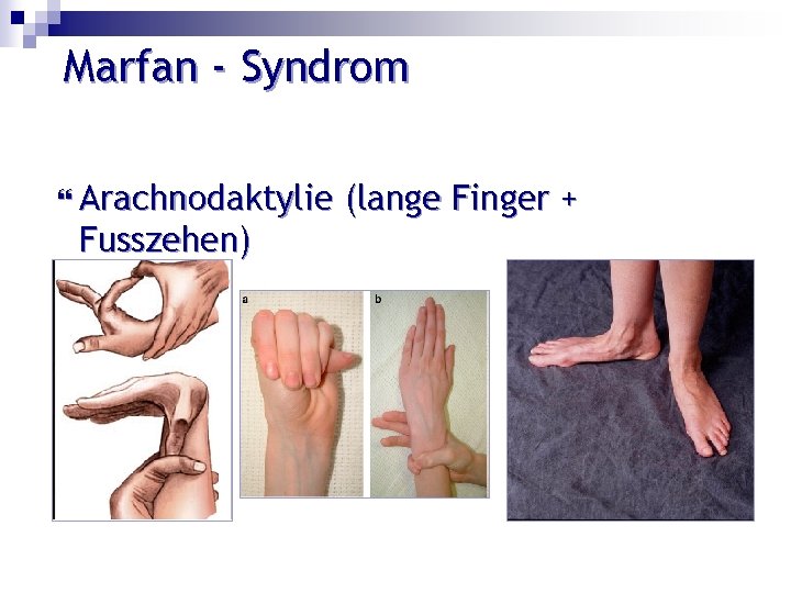 Marfan - Syndrom Arachnodaktylie Fusszehen) (lange Finger + 