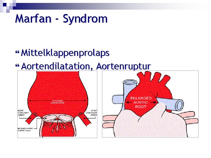 Marfan - Syndrom Mittelklappenprolaps Aortendilatation, Aortenruptur 