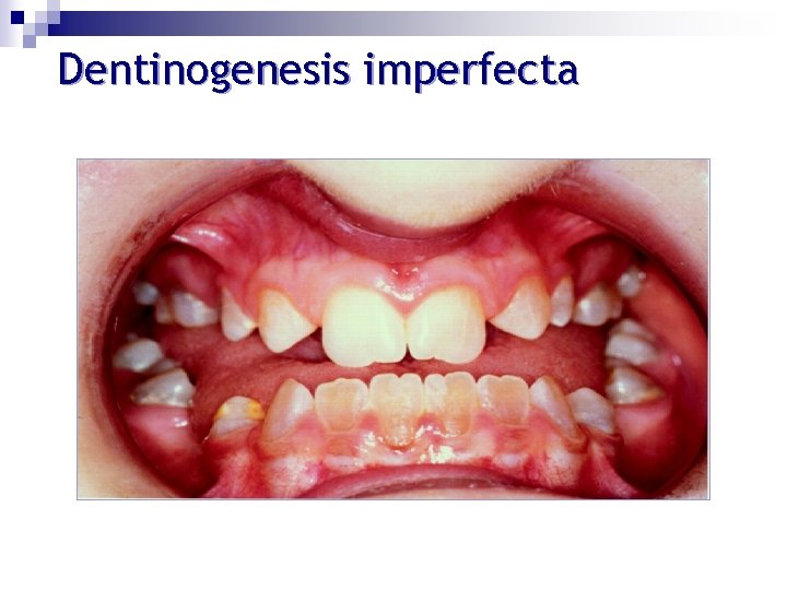 Dentinogenesis imperfecta 